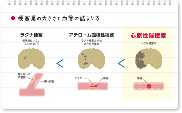 梗塞巣の種類と血管の詰まり方（ラクナ梗塞・心原性脳梗塞など）